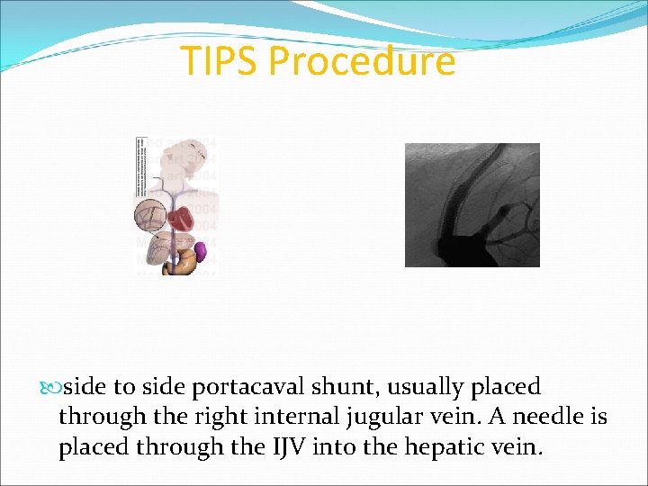 TIPS Procedure side to side portacaval shunt, usually placed through the right internal jugular