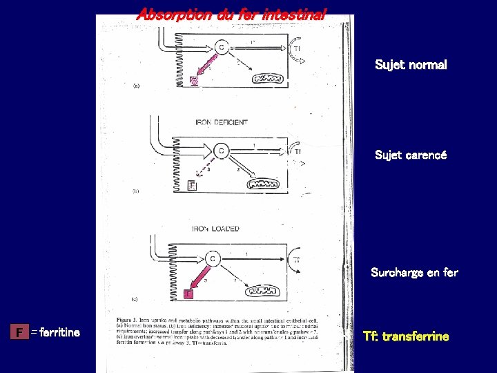 Absorption du fer intestinal Sujet normal Sujet carencé Surcharge en fer F = ferritine