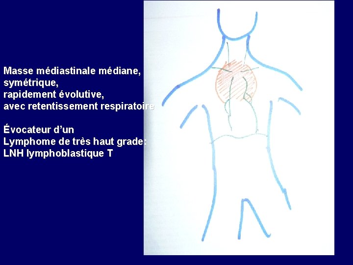 Masse médiastinale médiane, symétrique, rapidement évolutive, avec retentissement respiratoire Évocateur d’un Lymphome de très