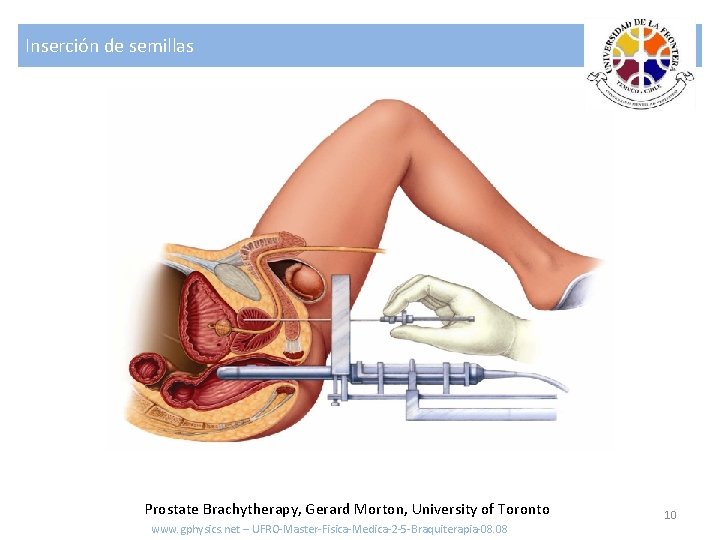 Inserción de semillas Prostate Brachytherapy, Gerard Morton, University of Toronto www. gphysics. net –