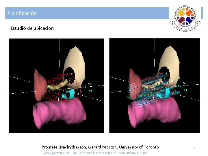 Planificación Estudio de ubicación Prostate Brachytherapy, Gerard Morton, University of Toronto www. gphysics. net