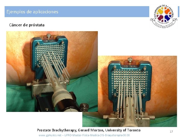 Ejemplos de aplicaciones Cáncer de próstata Prostate Brachytherapy, Gerard Morton, University of Toronto www.