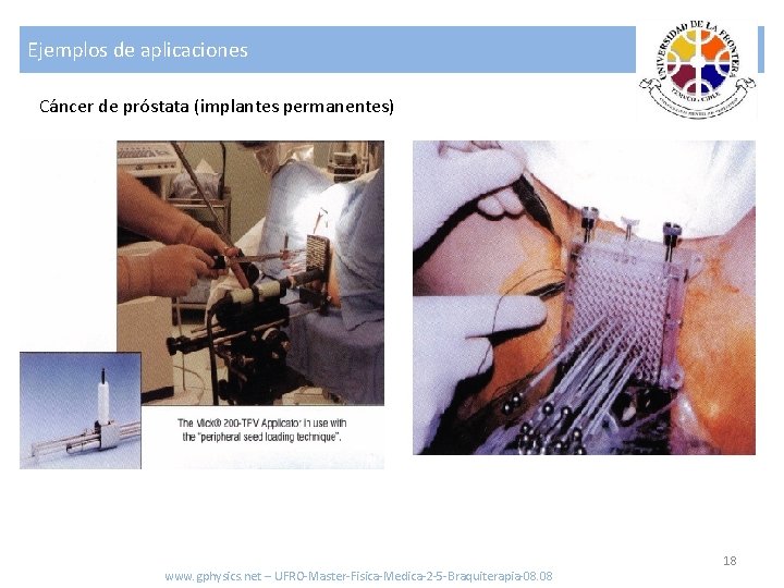 Ejemplos de aplicaciones Cáncer de próstata (implantes permanentes) www. gphysics. net – UFRO-Master-Fisica-Medica-2 -5