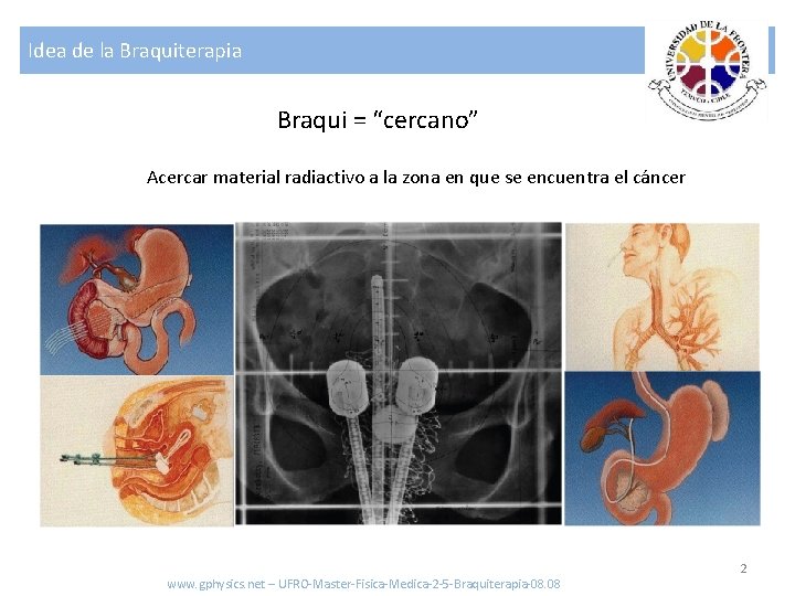 Idea de la Braquiterapia Braqui = “cercano” Acercar material radiactivo a la zona en