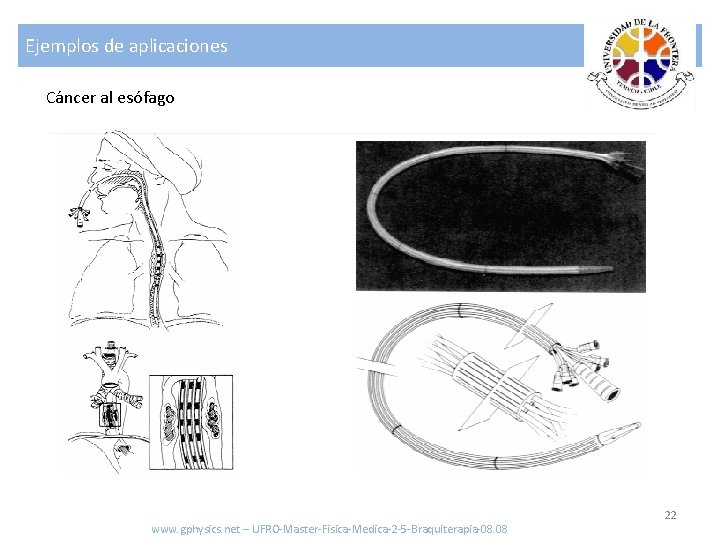 Ejemplos de aplicaciones Cáncer al esófago www. gphysics. net – UFRO-Master-Fisica-Medica-2 -5 -Braquiterapia-08. 08