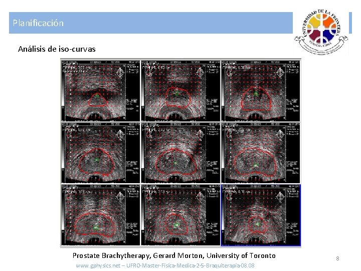 Planificación Análisis de iso-curvas Prostate Brachytherapy, Gerard Morton, University of Toronto www. gphysics. net