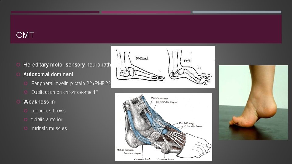 CMT Hereditary motor sensory neuropathy Autosomal dominant Peripheral myelin protein 22 (PMP 22) Duplication