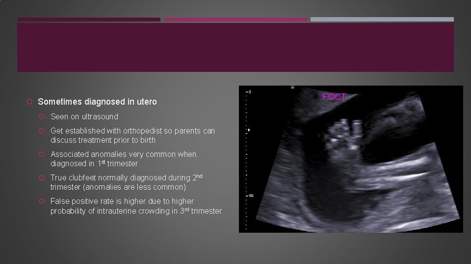  Sometimes diagnosed in utero Seen on ultrasound Get established with orthopedist so parents