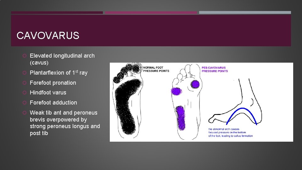 CAVOVARUS Elevated longitudinal arch (cavus) Plantarflexion of 1 st ray Forefoot pronation Hindfoot varus