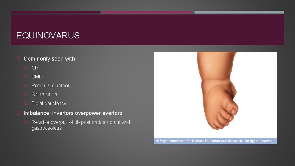 EQUINOVARUS Commonly seen with CP DMD Residual clubfoot Spina bifida Tibial deficiency Imbalance: invertors