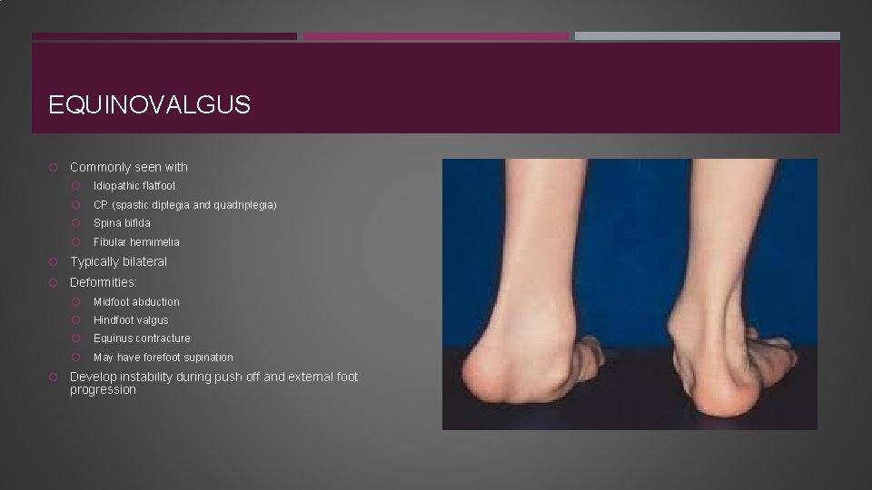 EQUINOVALGUS Commonly seen with Idiopathic flatfoot CP (spastic diplegia and quadriplegia) Spina bifida Fibular