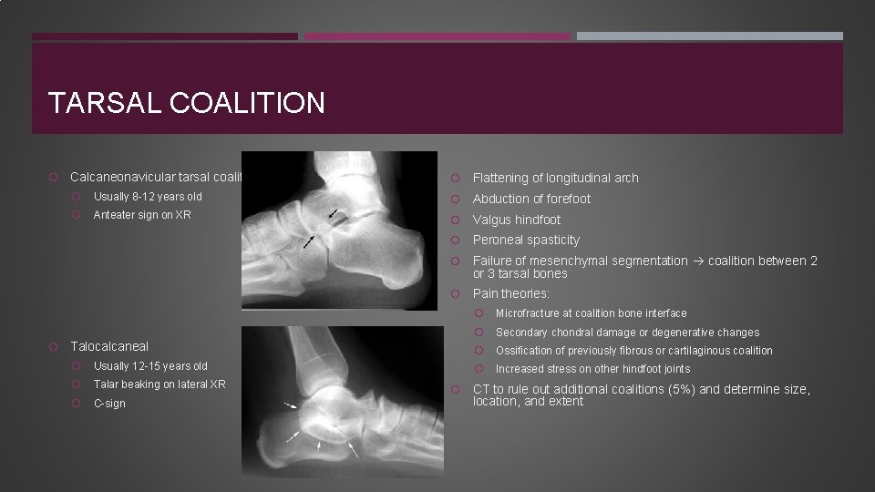 TARSAL COALITION Calcaneonavicular tarsal coalition Flattening of longitudinal arch Usually 8 -12 years old
