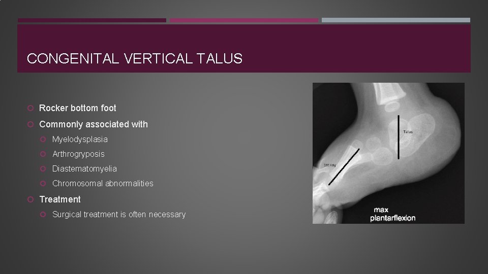 CONGENITAL VERTICAL TALUS Rocker bottom foot Commonly associated with Myelodysplasia Arthrogryposis Diastematomyelia Chromosomal abnormalities