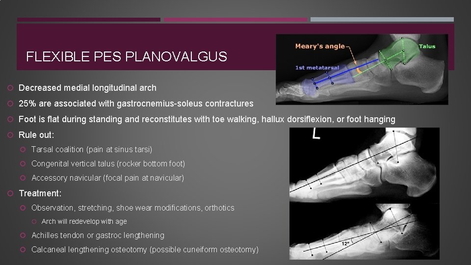 FLEXIBLE PES PLANOVALGUS Decreased medial longitudinal arch 25% are associated with gastrocnemius-soleus contractures Foot