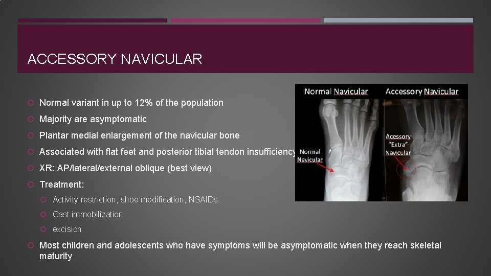 ACCESSORY NAVICULAR Normal variant in up to 12% of the population Majority are asymptomatic