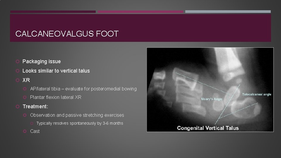 CALCANEOVALGUS FOOT Packaging issue Looks similar to vertical talus XR AP/lateral tibia – evaluate