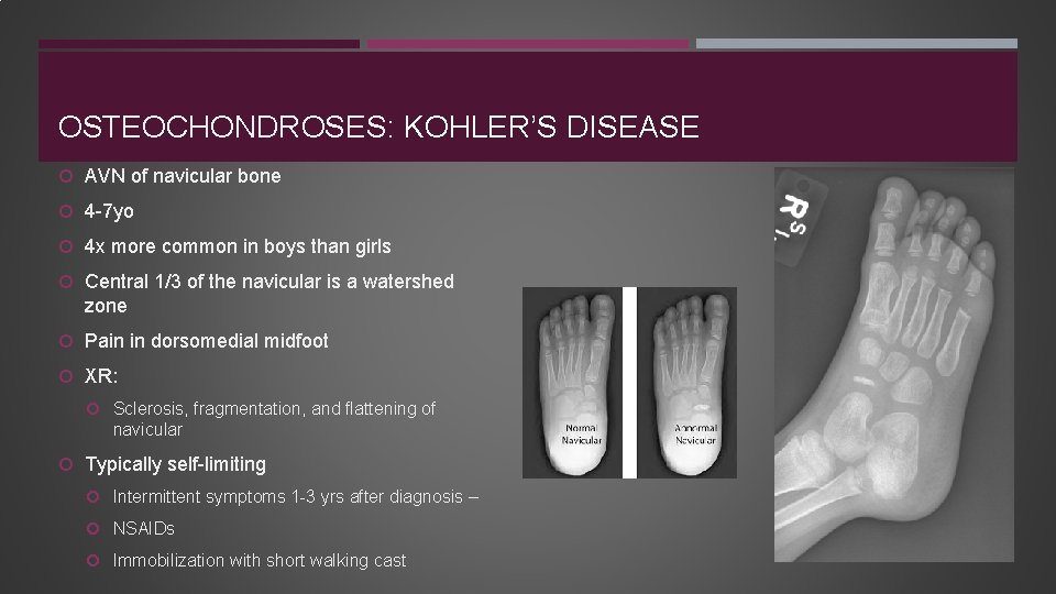 OSTEOCHONDROSES: KOHLER’S DISEASE AVN of navicular bone 4 -7 yo 4 x more common