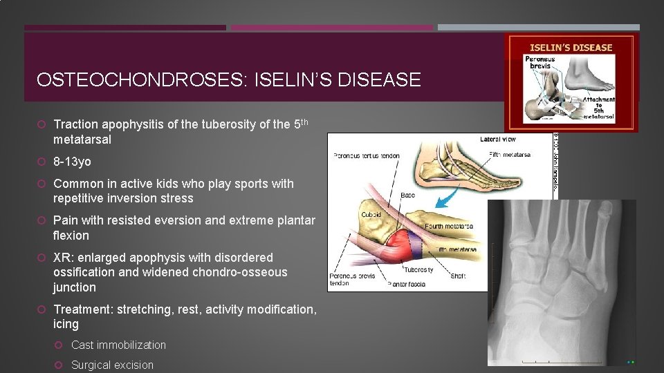 OSTEOCHONDROSES: ISELIN’S DISEASE Traction apophysitis of the tuberosity of the 5 th metatarsal 8