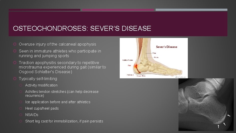OSTEOCHONDROSES: SEVER’S DISEASE Overuse injury of the calcaneal apophysis Seen in immature athletes who
