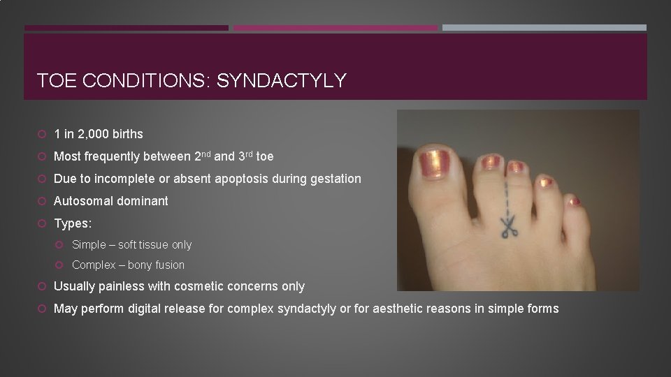 TOE CONDITIONS: SYNDACTYLY 1 in 2, 000 births Most frequently between 2 nd and