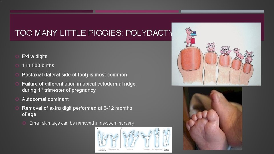 TOO MANY LITTLE PIGGIES: POLYDACTYLY Extra digits 1 in 500 births Postaxial (lateral side