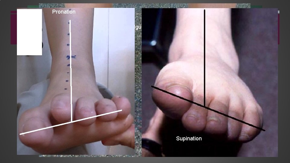 Pronation Valgus = Eversion Supination Varus = Inversion 