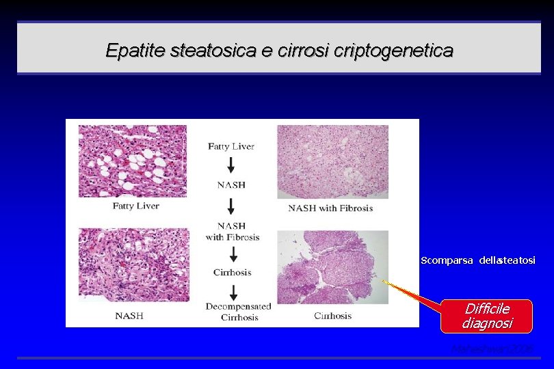 Epatite steatosica e cirrosi criptogenetica Scomparsa dellasteatosi Difficile diagnosi Maheshwari 2006 