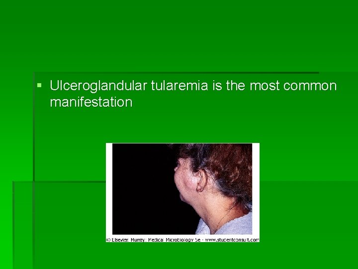 § Ulceroglandular tularemia is the most common manifestation 
