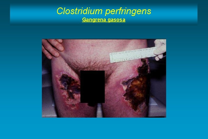 Clostridium perfringens Gangrena gasosa 