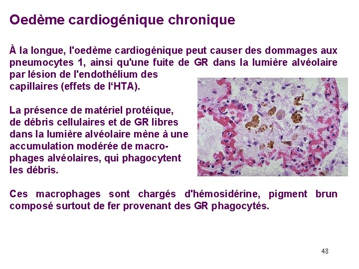 Oedème cardiogénique chronique À la longue, l'oedème cardiogénique peut causer des dommages aux pneumocytes