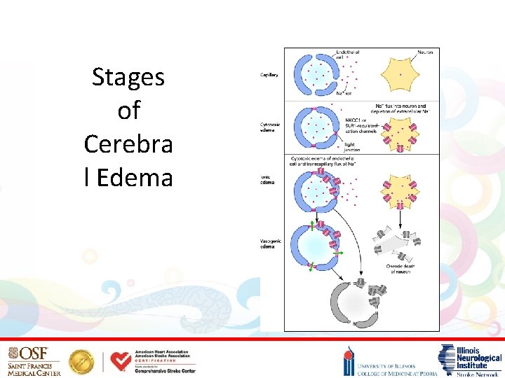 Stages of Cerebra l Edema 