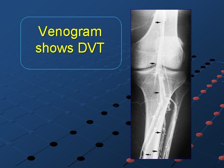 Venogram shows DVT 