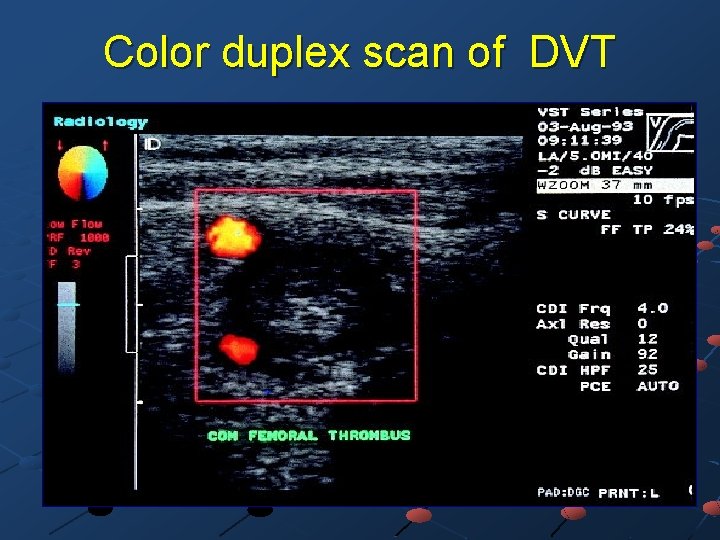 Color duplex scan of DVT 