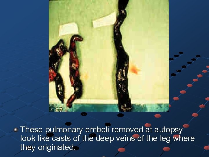 These pulmonary emboli removed at autopsy look like casts of the deep veins of