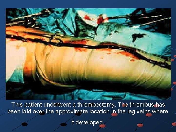  This patient underwent a thrombectomy. The thrombus has been laid over the approximate