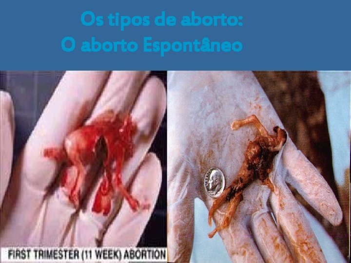 Os tipos de aborto: O aborto Espontâneo 