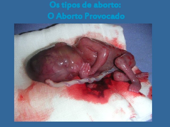Os tipos de aborto: O Aborto Provocado 