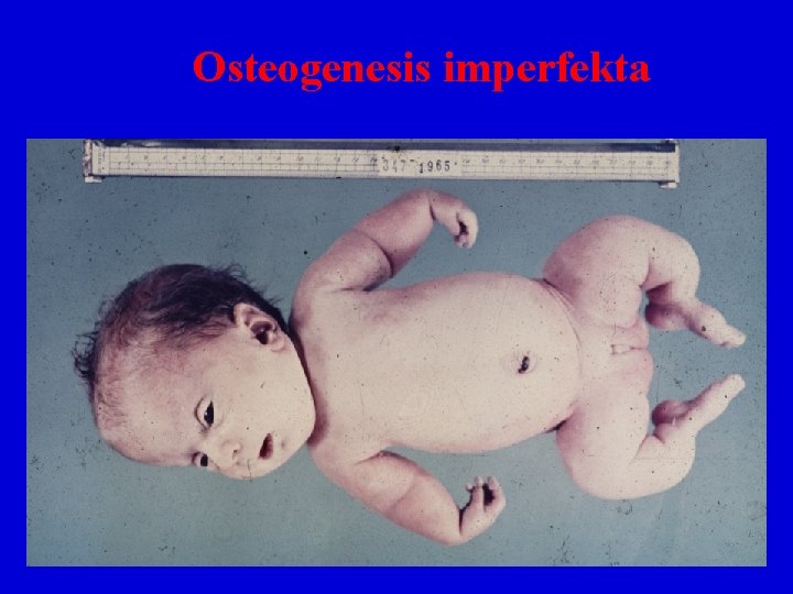Osteogenesis imperfekta 