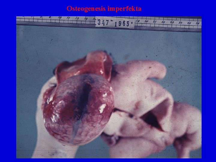 Osteogenesis imperfekta 