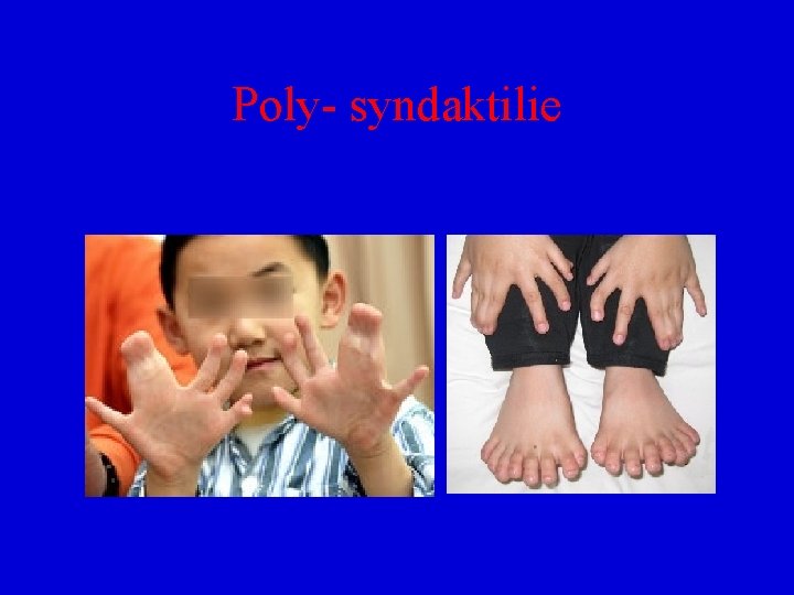 Poly- syndaktilie 