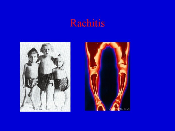 Rachitis 