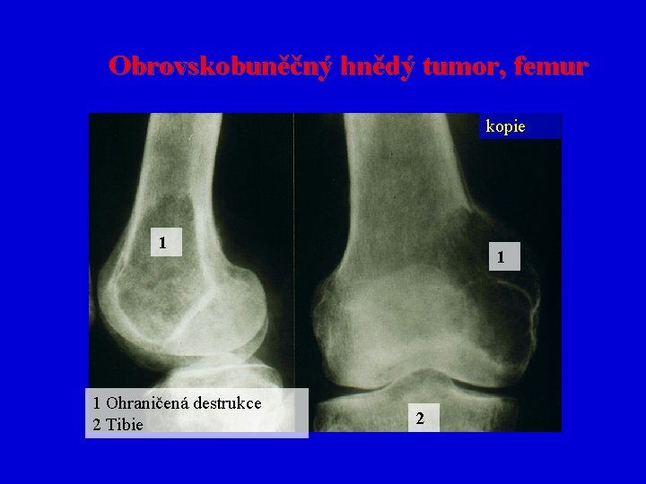 Obrovskobuněčný hnědý tumor, femur kopie 1 1 Ohraničená destrukce 2 Tibie 1 2 