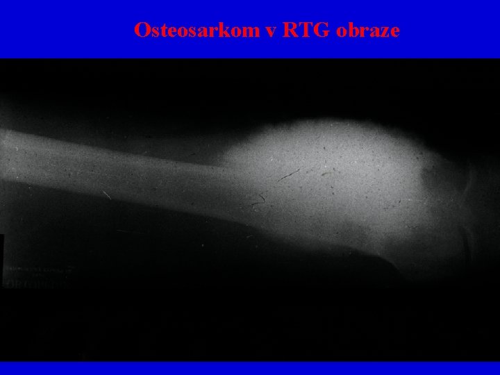 Osteosarkom v RTG obraze 