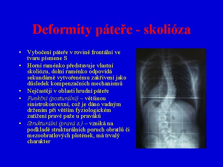 Deformity páteře - skolióza • Vybočení páteře v rovině frontální ve tvaru písmene S