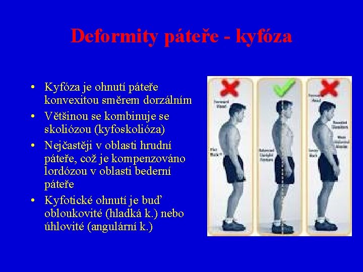 Deformity páteře - kyfóza • Kyfóza je ohnutí páteře konvexitou směrem dorzálním • Většinou