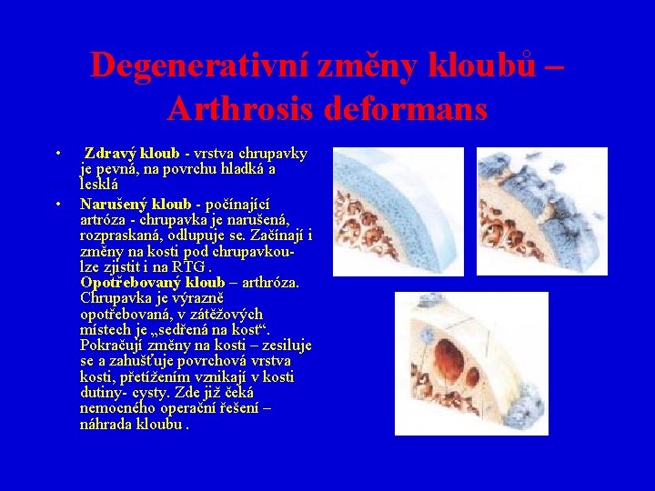 Degenerativní změny kloubů – Arthrosis deformans • • Zdravý kloub - vrstva chrupavky je