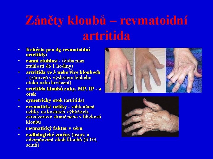Záněty kloubů – revmatoidní artritida • • Kritéria pro dg revmatoidní artritidy: ranní ztuhlost
