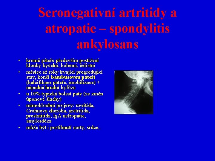 Seronegativní artritidy a atropatie – spondylitis ankylosans • • • kromě páteře především postižení