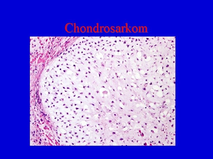 Chondrosarkom 