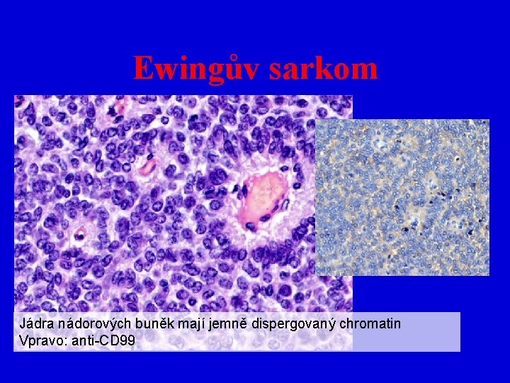 Ewingův sarkom Jádra nádorových buněk mají jemně dispergovaný chromatin Vpravo: anti-CD 99 